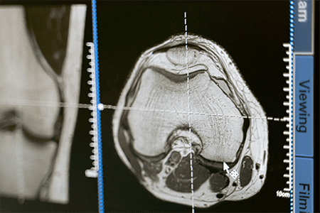 Coronary CT Angiography with AI plaque analysis